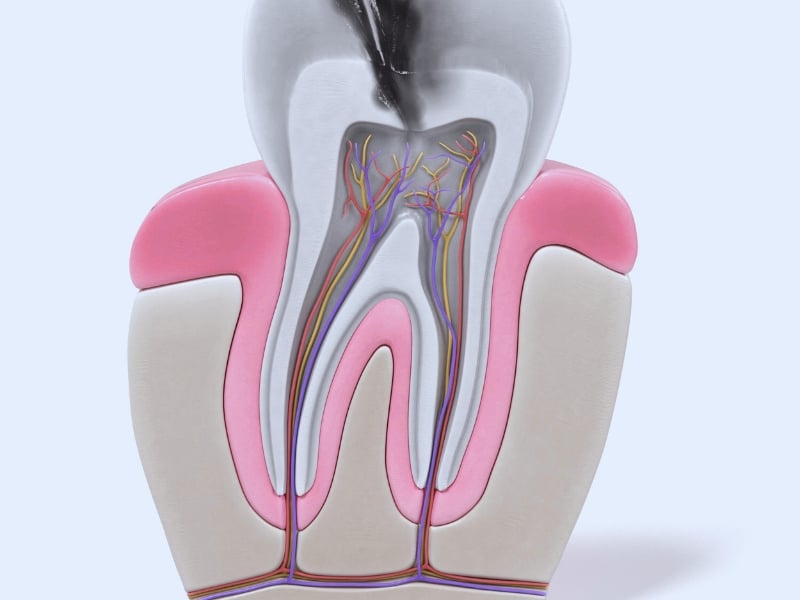 Illustration of a tooth showing nerves, pulp infection, and decay, demonstrating key principles of root canal therapy.