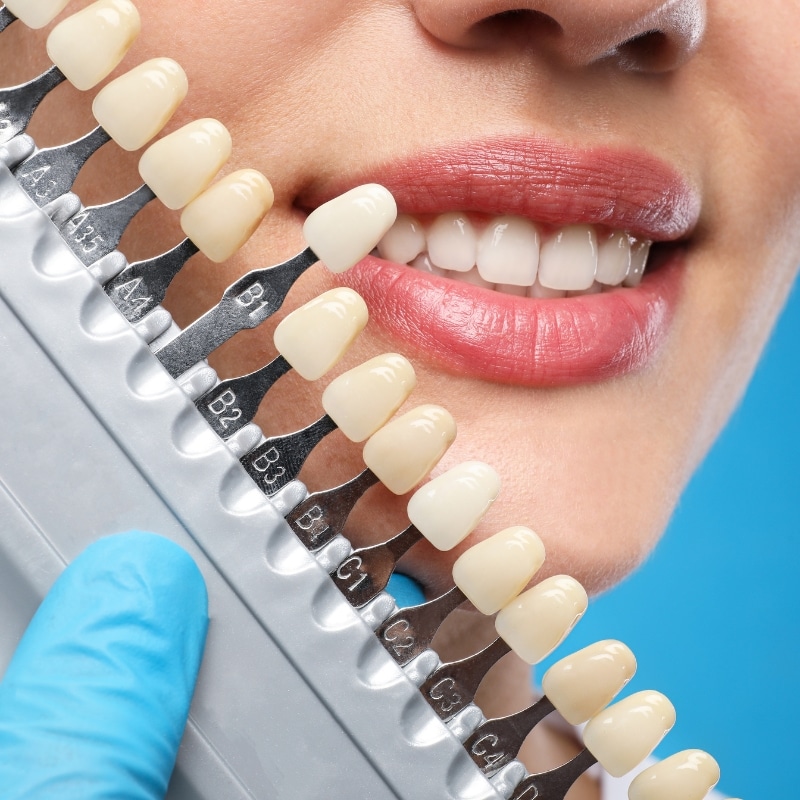 Cosmetic dentistry tooth shade guide comparison with patient’s natural teeth for whitening treatment.