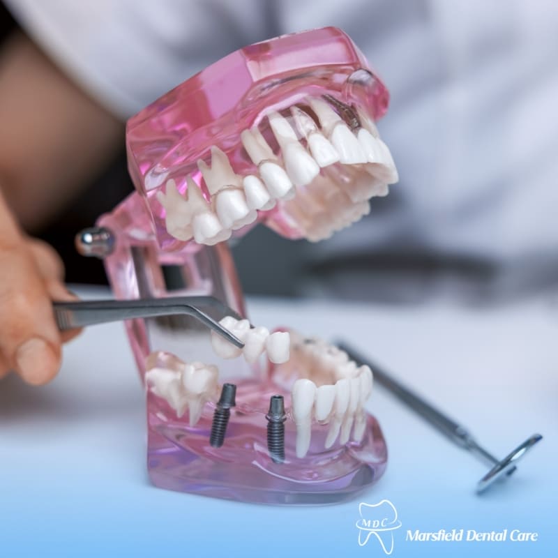 Image presents Dental Bridge Turrella