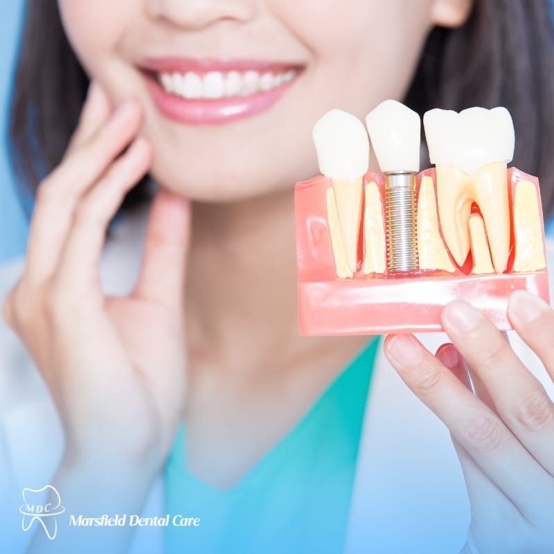 image presents Dental Implant Ermington