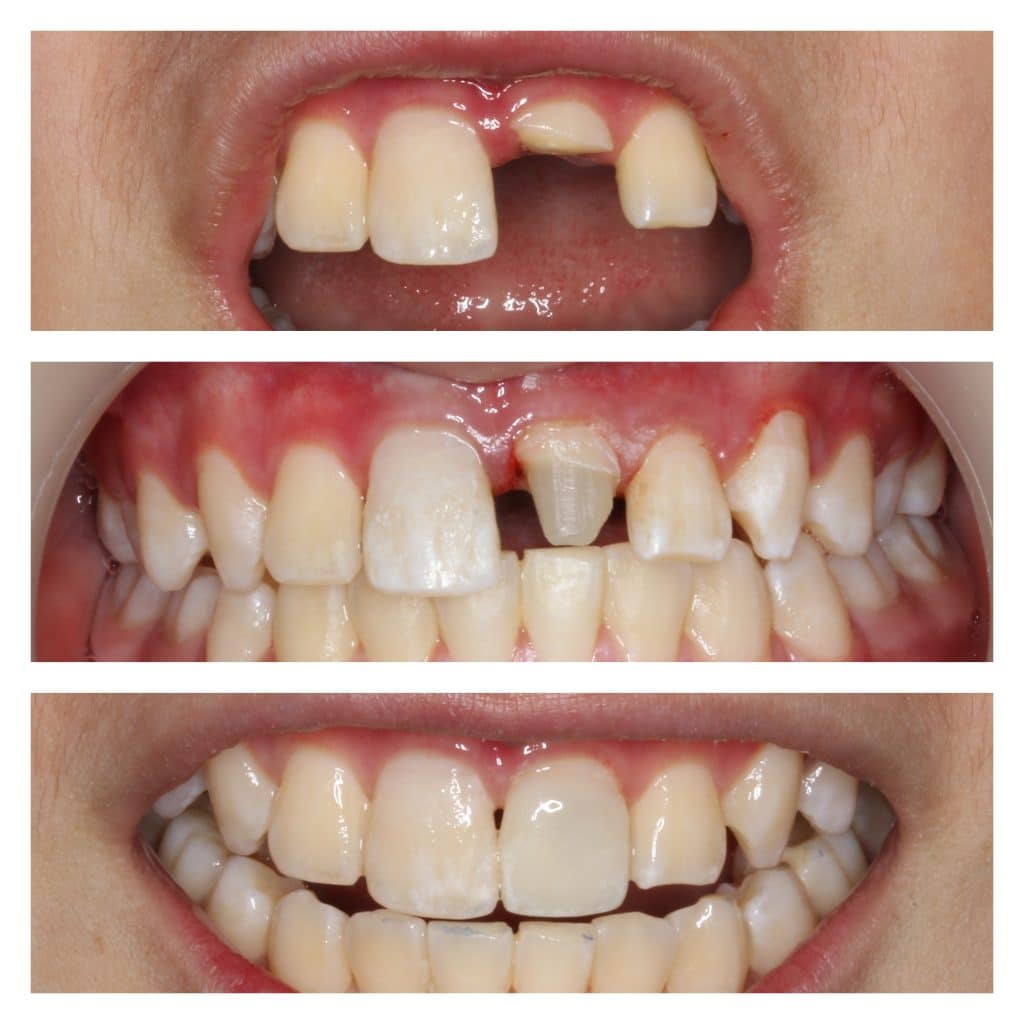 Before and after of 3D Printed Veneers and Restorations