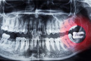X-ray image of a dental scan highlighting an impacted wisdom tooth in the lower jaw, emphasizing the need for tips on how to soothe wisdom tooth pain effectively.