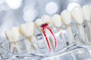 Close-up view of a dental model showing a tooth with exposed root canals, providing insight into how long a root canal lasts.