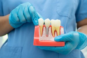 Dentist holding a dental model showing a root canal and dental implant, explaining how long a root canal lasts compared to others.