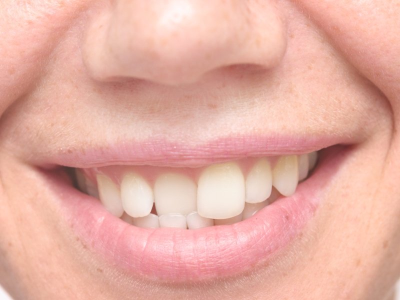 Smiling mouth with crooked teeth, showing misalignment and crowding of front teeth.