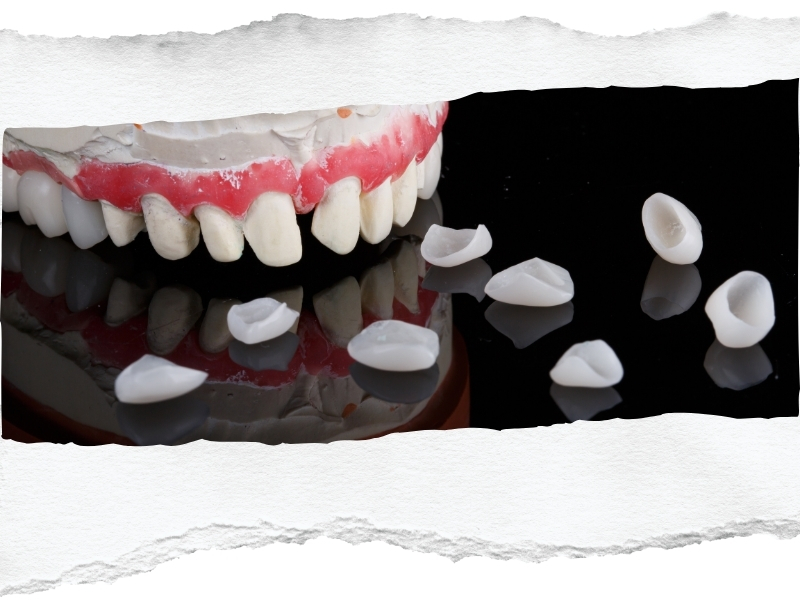 Broken dental model with fallen crowns scattered, illustrating dental crown falls off issue.