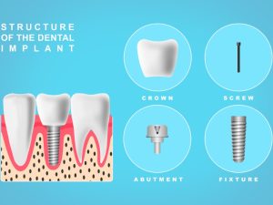 Diagram of the structure of metal free implants, including crown, screw, abutment, and fixture components.