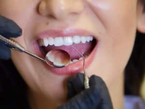 A dentist examining a woman’s teeth to check if teeth are misaligned during a dental consultation.