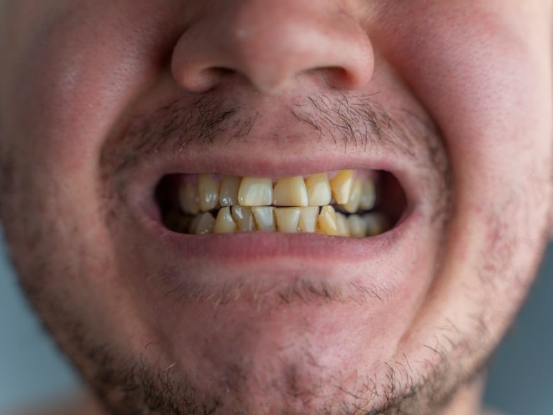 A close-up of a man with yellowed and crooked teeth, showing how teeth are misaligned due to wear.