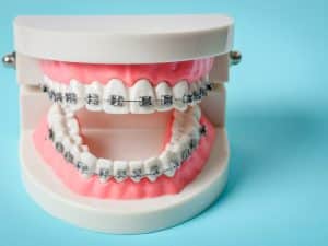 A dental model showing how braces are used to correct teeth that are misaligned.