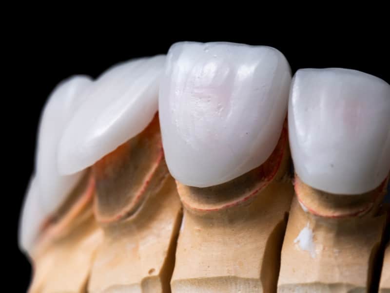 Detailed view of veneer materials placed on a dental model, illustrating tooth coverage.