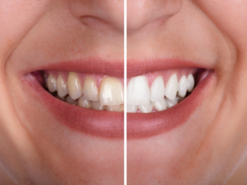 A person smiling with bright white teeth and the other part is yellowish illustrates the recommended frequency of teeth whitening treatments.