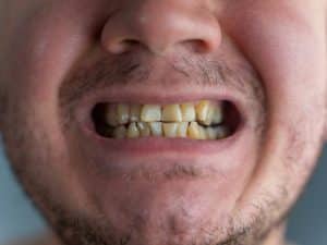 Image of a person with unhygienic teeth, highlighting the importance of managing Teeth Whitening Frequency for better oral health.