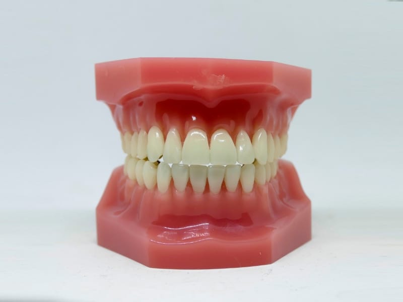 Close-up of a dental model highlighting a front tooth with a dental filling.