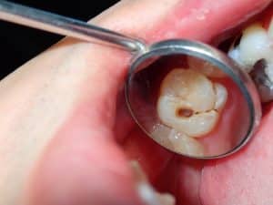 close up view of a decayed tooth