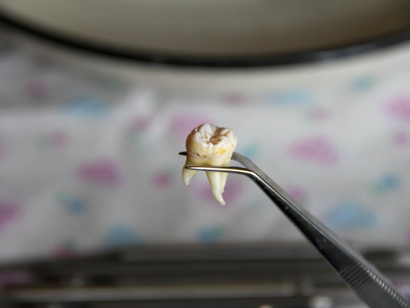 A close-up image of a molar with visible signs of infection, highlighting the need for infected molar extraction.