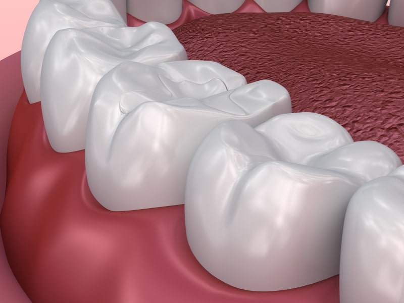 Close-up of a tooth with a dental fissure sealant, preventing cavities.