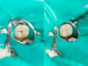 Close-up view of a tooth with and without dental fissure sealant.