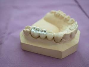 A close-up of a dental model with silver dental fillings on the teeth.