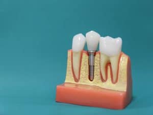 A dental model showcasing different types of dental implants, including a screw-type implant and a tooth-supported bridge.