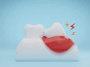 A tooth with a large red cavity, emitting lightning bolts, next to a healthy tooth. Hot food may trigger tooth pain.