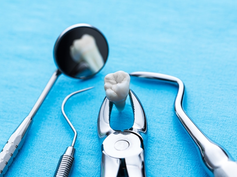 Extracted infected tooth with dental tools arranged on a blue surface after a tooth extraction procedure.