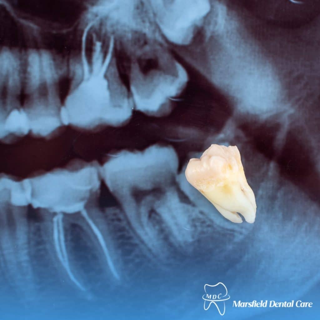 Wisdom tooth extraction X-ray with a removed impacted tooth, showcasing dental care and oral surgery for impacted wisdom teeth.