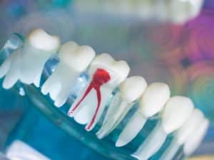 Close-up of a dental model showing an inflamed root canal, highlighting potential causes of bleeding gums when brushing.