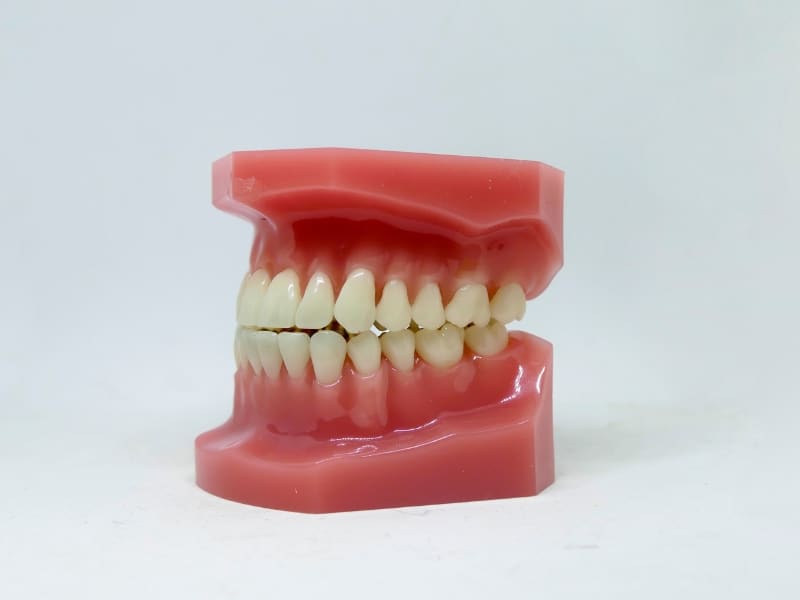 Dental model showing teeth and gums, illustrating how to prevent gum recession.