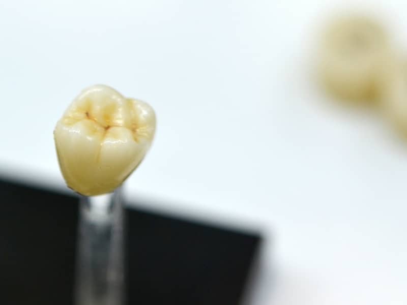Close-up model of a loose dental crown used in tooth restoration procedures.