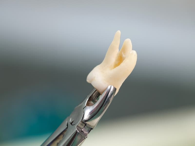 A removed molar, possibly from a DIY tooth extraction, held by surgical forceps.