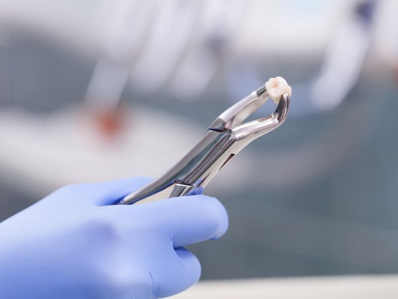 A gloved hand holds forceps with a removed tooth, illustrating a form of preventive dental treatment.