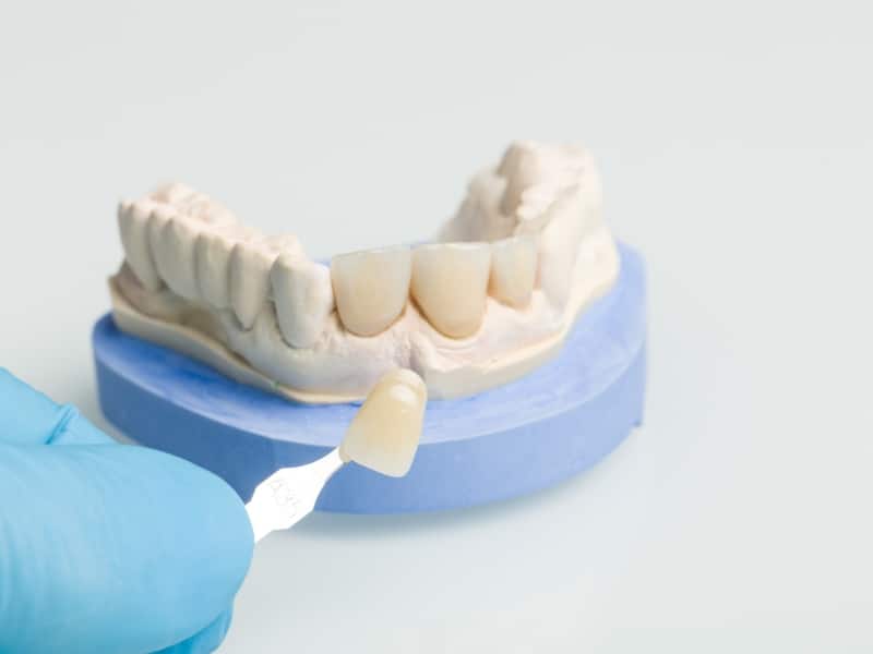 Dental technician matches loose dental crown shade using a model for proper colour selection and restoration.