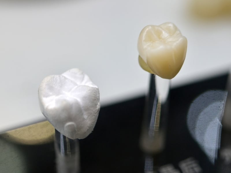 Dental crowns comparison showing materials that impact dental crown longevity.