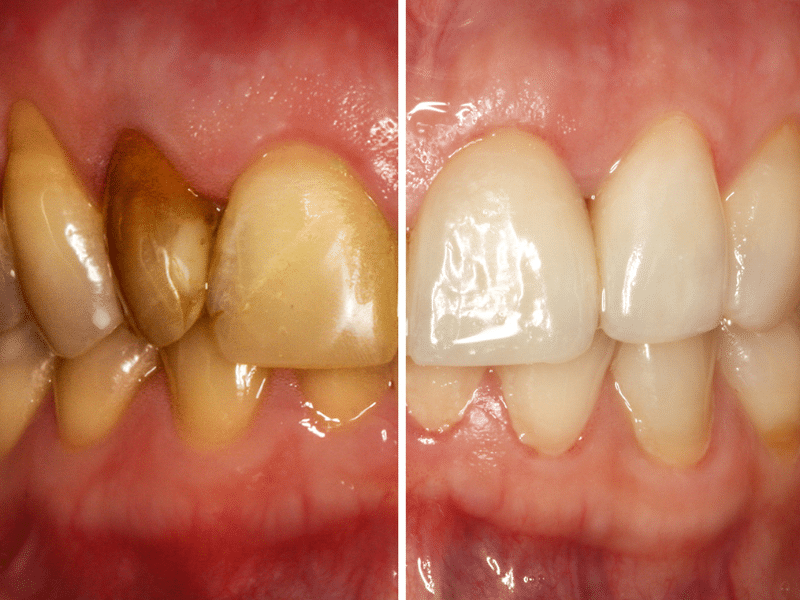 Closeup before and after teeth restoration showing stained teeth and cleaned white teeth.