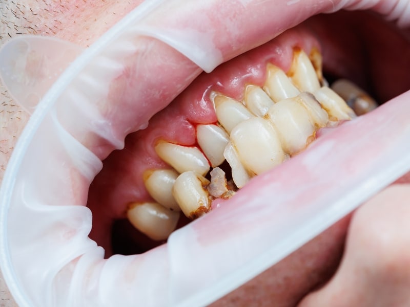 Close-up of decayed teeth showing lack of preventative dental practice.