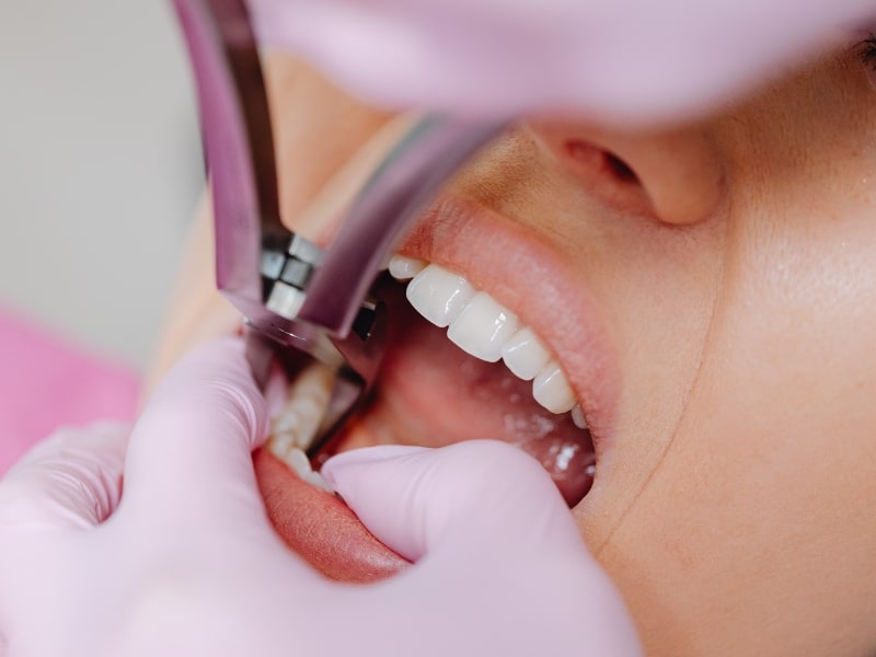 Tooth Restoration procedure using dental extraction tools