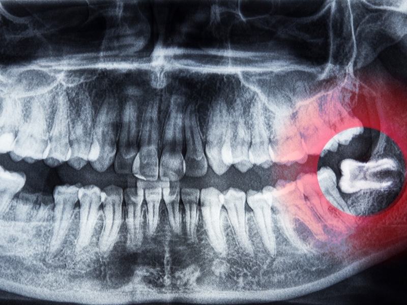 Dental X-ray showing impacted molar requiring wisdom tooth extraction.