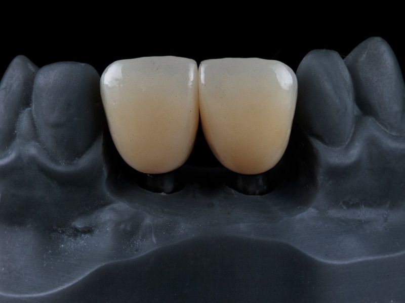 Front dental implants fitted with a crown for chipped tooth restoration.