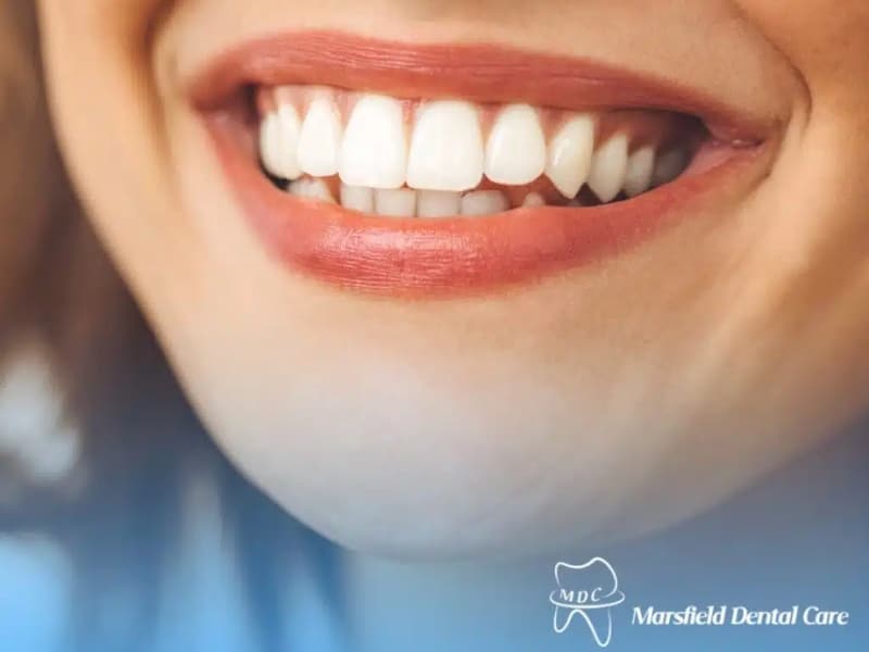 Dental Bonding results showing smooth, even, white front teeth