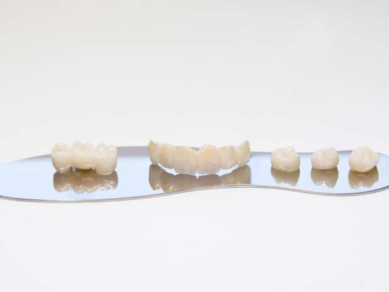 Different dental bridge and crowns on display reflecting why do crowns need to be replaced.