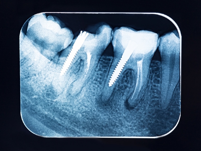 X-ray showing lower molars with endodontic posts and surrounding bone detail