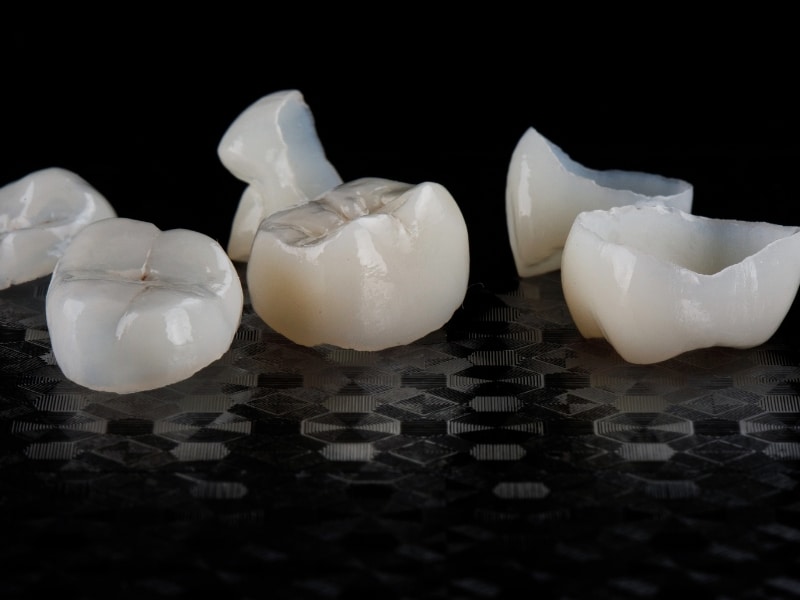 High-detail image of molar crowns demonstrating wear and why do crowns need to be replaced.