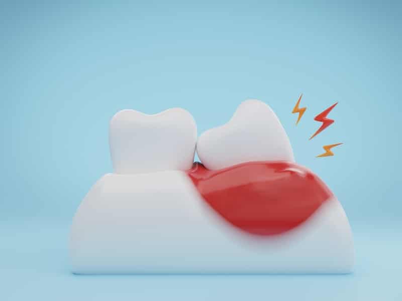 Emergency gum treatment illustration showing bleeding gums and tooth pain