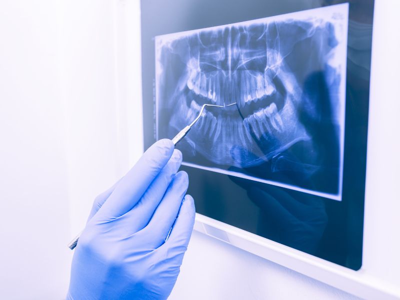dentist reviewing panoramic results after getting a dental xray