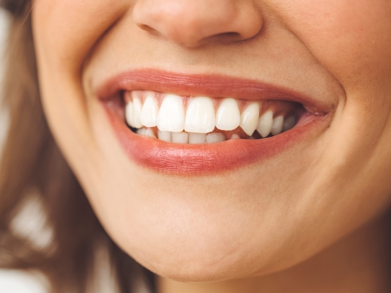 Close-up of a woman smiling with bright white teeth after teeth cosmetic procedures.