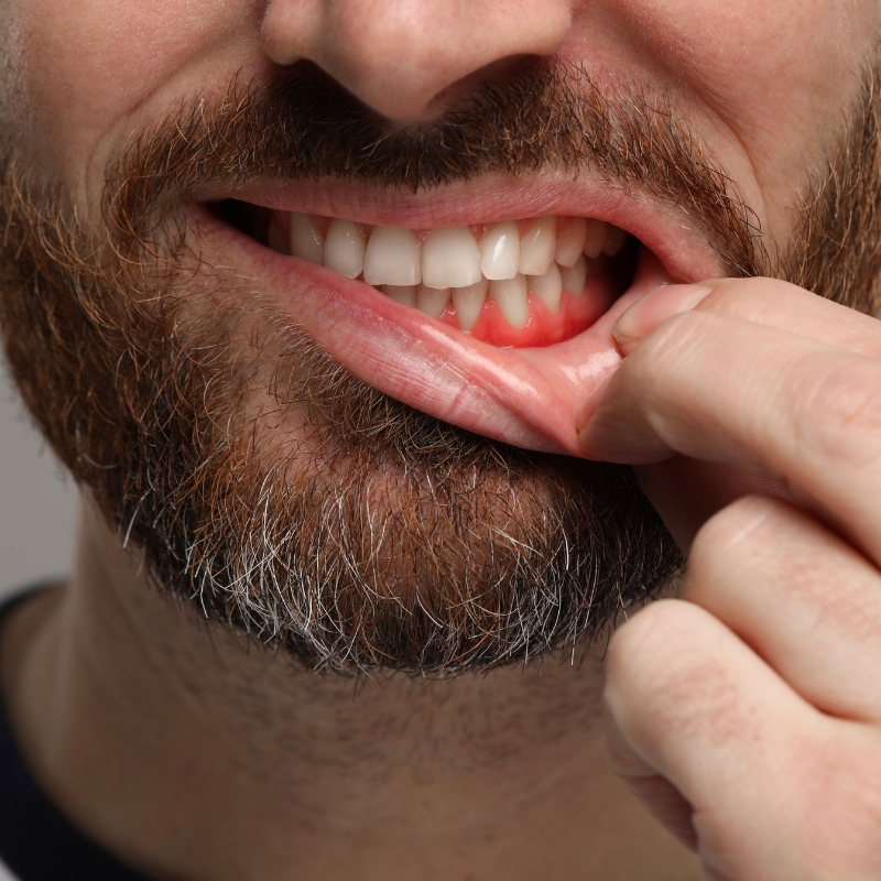 Close-up of a man pulling down his lip to show red, inflamed gums, highlighting the need for a dental appointment.