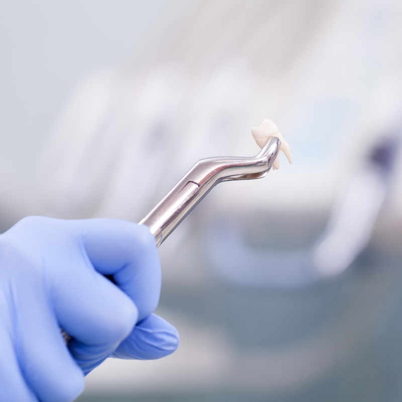 Gloved hand holding forceps with an extracted molar, illustrating a safe and successful professional tooth extraction procedure.