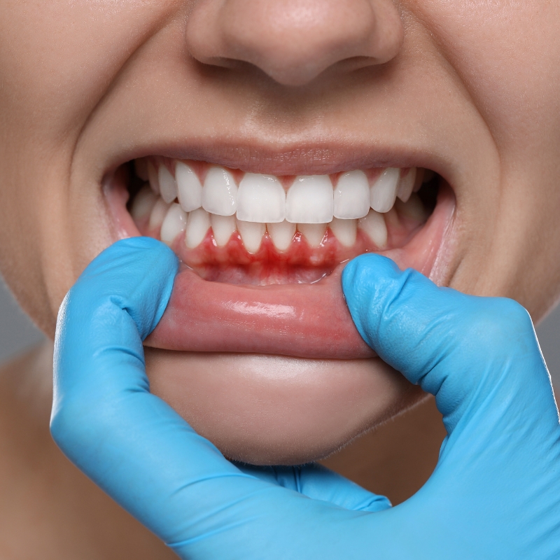 Close-up of gloved hands pulling down a patient's lip, revealing bleeding gums that may indicate a dental emergency.