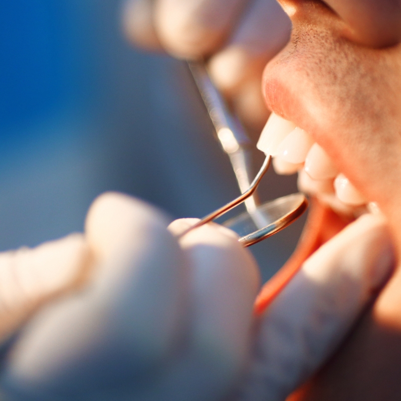 Dentist using a mouth mirror and probe to examine teeth during a patient's dental appointment.